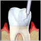 gum disease treatment duluth