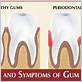 gum disease treatment elmhurst il