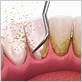 gum disease treatment foutain valley