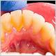 gum disease treatment in buford