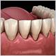 gum disease treatment in canyon country