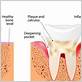 gum disease treatment in kensington