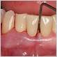 gum disease treatment in mclean