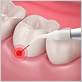 gum disease treatment in memphis