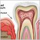 gum disease treatment in newport beach ca