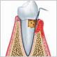 gum disease treatment in temecula