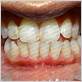 gum disease treatment karnataka