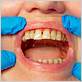 gum disease treatment meridian id