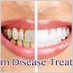 gum disease treatment newton county