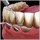 gum disease treatment on nhs