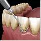 gum disease treatment pittsfield ma