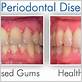 gum disease treatment preston