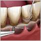 gum disease treatment scaling root planing