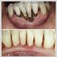 gum disease treatment st. louis