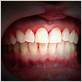 gum disease treatment tysons corner va