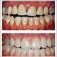 gum disease treatment uk