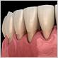 gum disease treatment west babylon