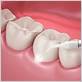 gum disease treatments in hoover