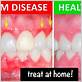 gum disease treatments in indian land