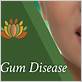 gum disease treatments in la jolla
