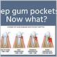 gum disease treatments in lafayette