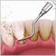 gum disease treatments irvine