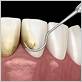 gum disease treatments jonesboro ar