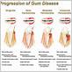 gum disease treatments queens