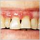 gum disease treatments whittier