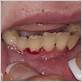 gum disease vitamin deficiency