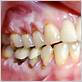 gum disease vs oral cancer
