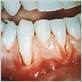 gum disease white bumps