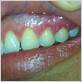 gum disease white spots