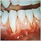 gum disease white spots on gums