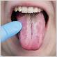 gum disease white tounge