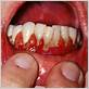 gum diseases lichen planus