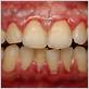 gum diseases pictures