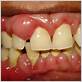 gum inflammation around one tooth