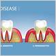 gum periodontal disease treatment