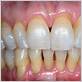 gum recession disease