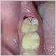 gum separating from back molar