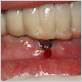 gum swelling around implant