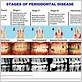 gum tissue descriptors for periodontal disease