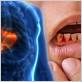 gums bleeding liver disease
