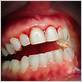 gums stopped bleeding after waterpik