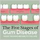 gums with and without perio disease