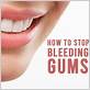 gums won t stop bleeding