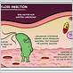 h pylori gum disease