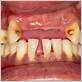 hammond gum and bone disease