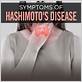 hashimoto's and gum disease